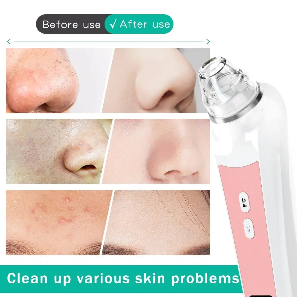 Electric Blackhead Remover Vacuum Acne Pore Cleaner Black Dots